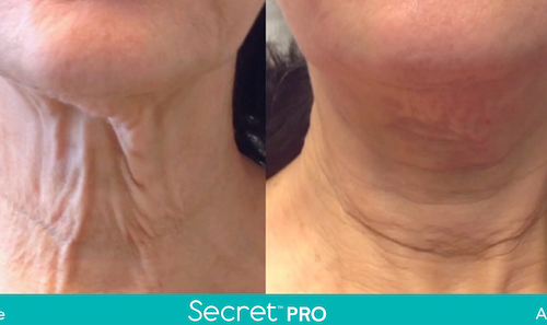 Advanced Skin Tightening Treatment Mississauga Oakville